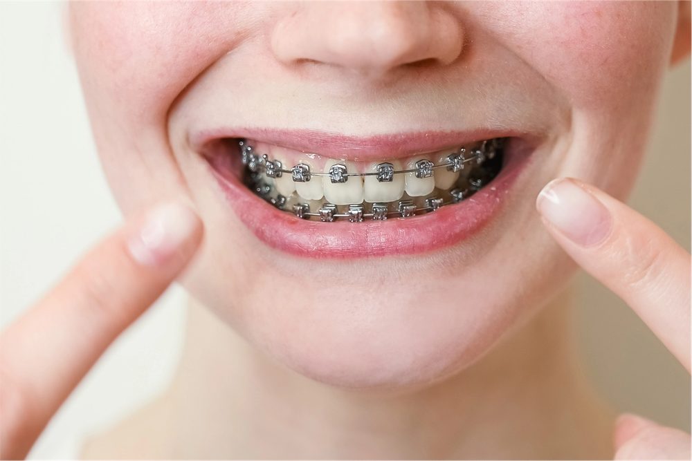 Close-up of a smile with self-ligating braces