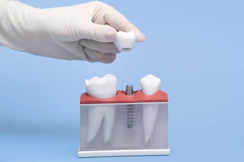 A gloved hand placing a crown on a dental implant model